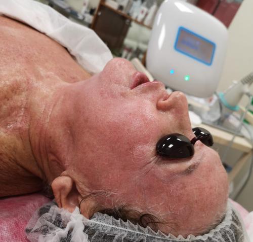 Есть ли какие-то противопоказания для лазерного омоложения кожи