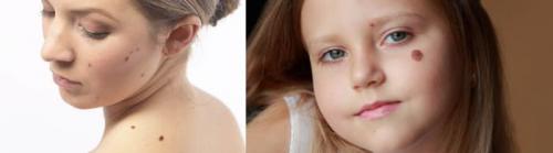 Как убрать возрастные пигментные пятна. Старческие пятна на лице: лечение 03