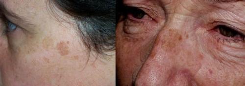 Как убрать возрастные пигментные пятна. Старческие пятна на лице: лечение 02