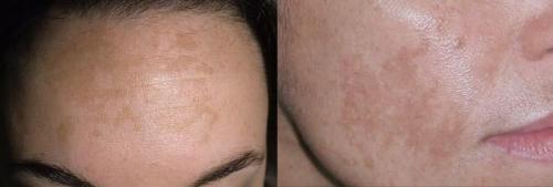 Как убрать возрастные пигментные пятна. Старческие пятна на лице: лечение 01