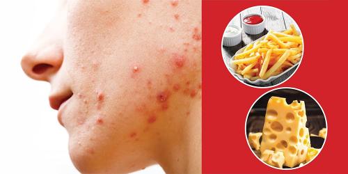 Какие фрукты можно при акне. АКНЕ И ДИЕТА: МОЛОЧНЫЕ ПРОДУКТЫ, ЖИРЫ И УГЛЕВОДЫ