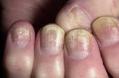 Онихомикоз лечение в домашних условиях. Онихомикоз