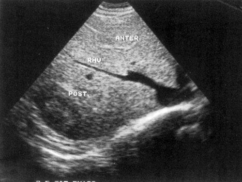 Каковы размеры печени