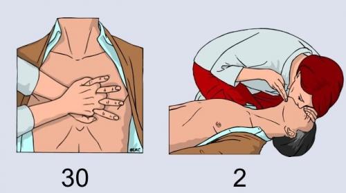 Реанимация ели. Что такое сердечно-легочная реанимация и как правильно ее провести