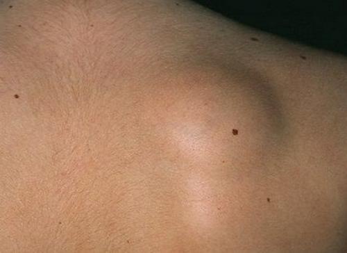 В чем разница между липомой и атеромой и нужно ли их удалять. Лечение липом 03