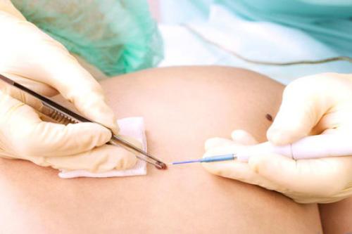 В чем разница между липомой и атеромой и нужно ли их удалять. Лечение липом 04